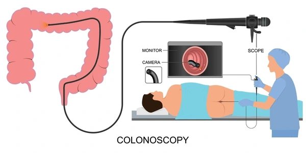 Colonoscopy